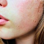 How to Get Rid of a Heat Rash: 4 Ways That Actually Work